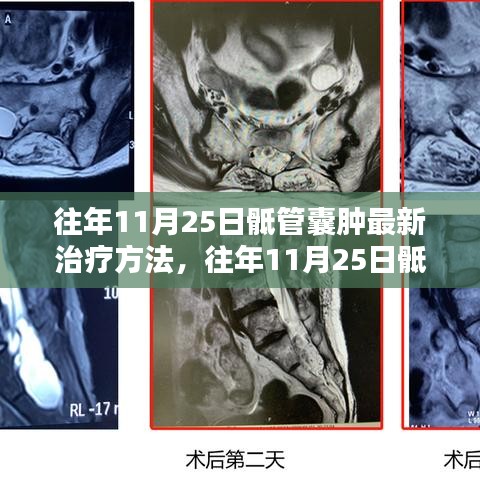 往年11月25日骶管囊腫最新治療方法研究及探索