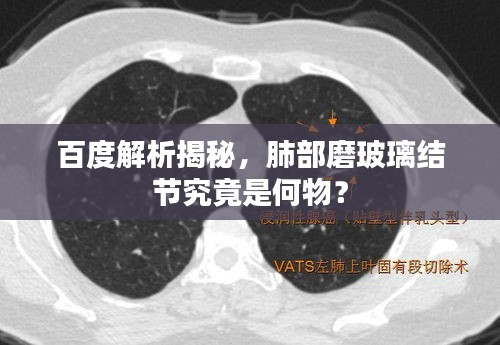 百度解析揭秘,肺部磨玻璃結節究竟是何物?